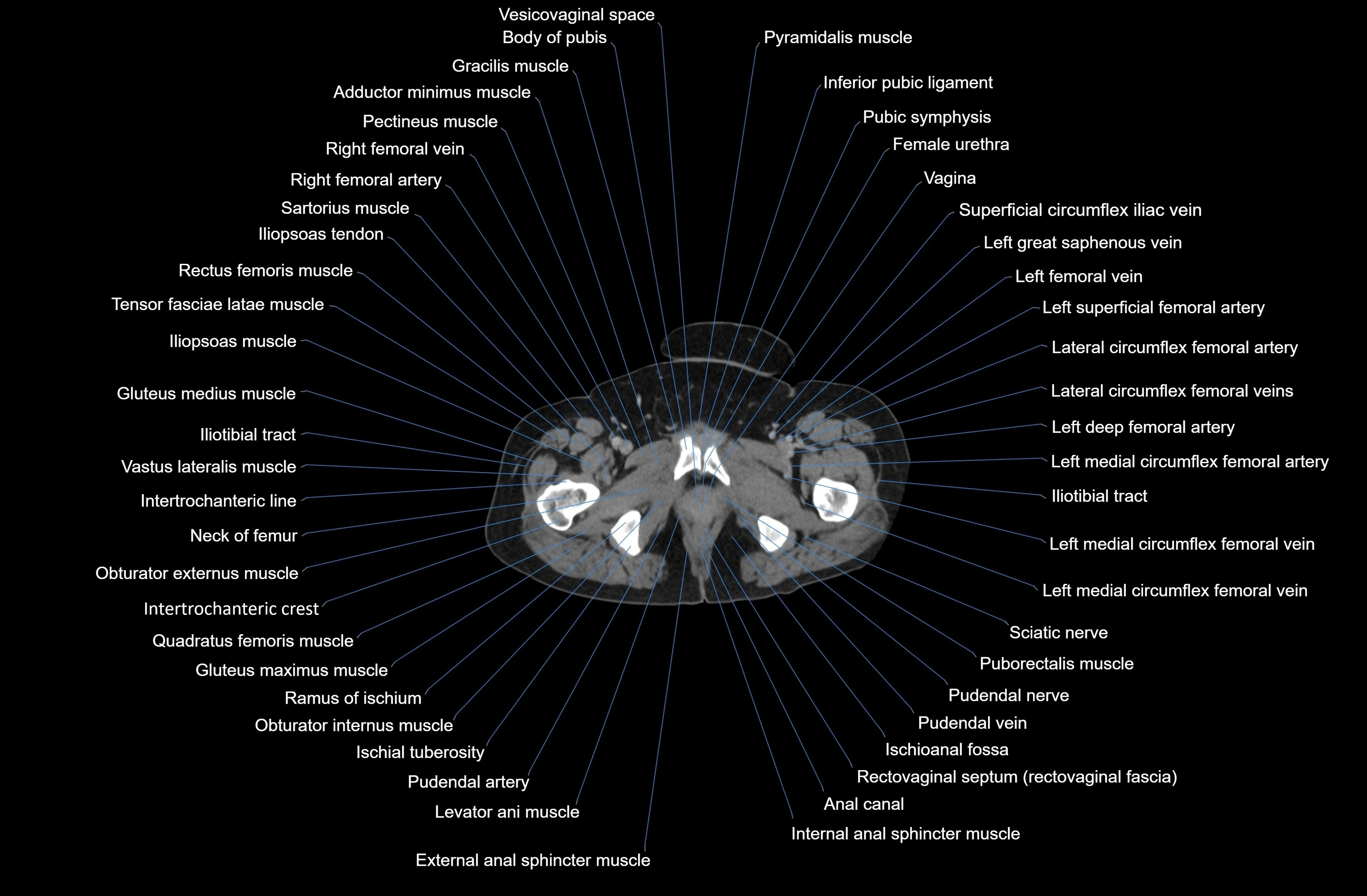 CT Abdomen axial cross sectional anatomy labelled radiology image-00100.webp